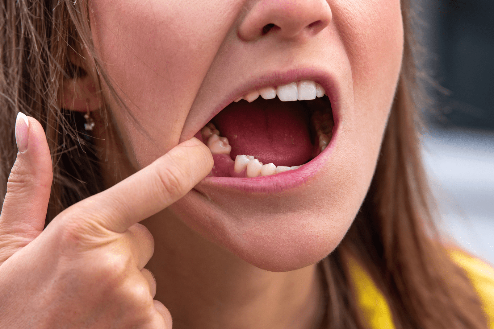 tooth extraction gorgeous smiles dental chicopee, ma