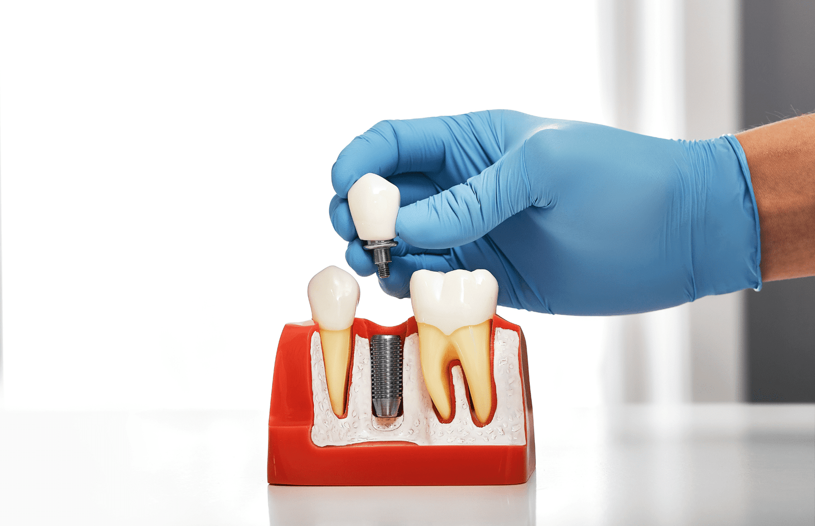 Implant-Supported Dentures gorgeous smiles dental in farmington, CT (2) (1)