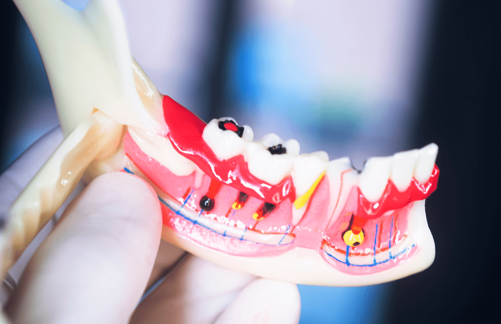 Root Canal & Endodontics gorgeous smiles dental in farmington, CT