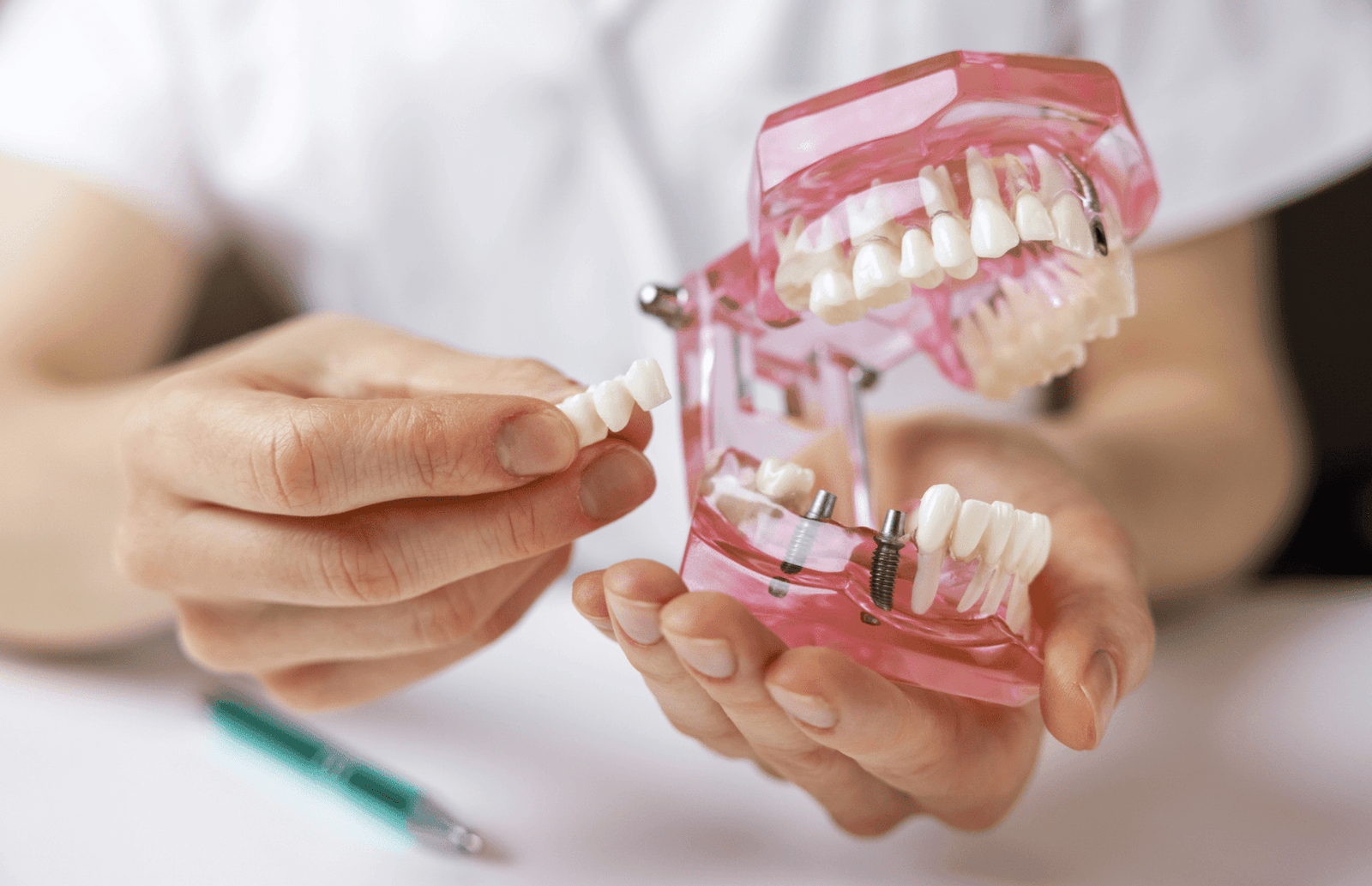 Implant-Supported Dentures in Northampton