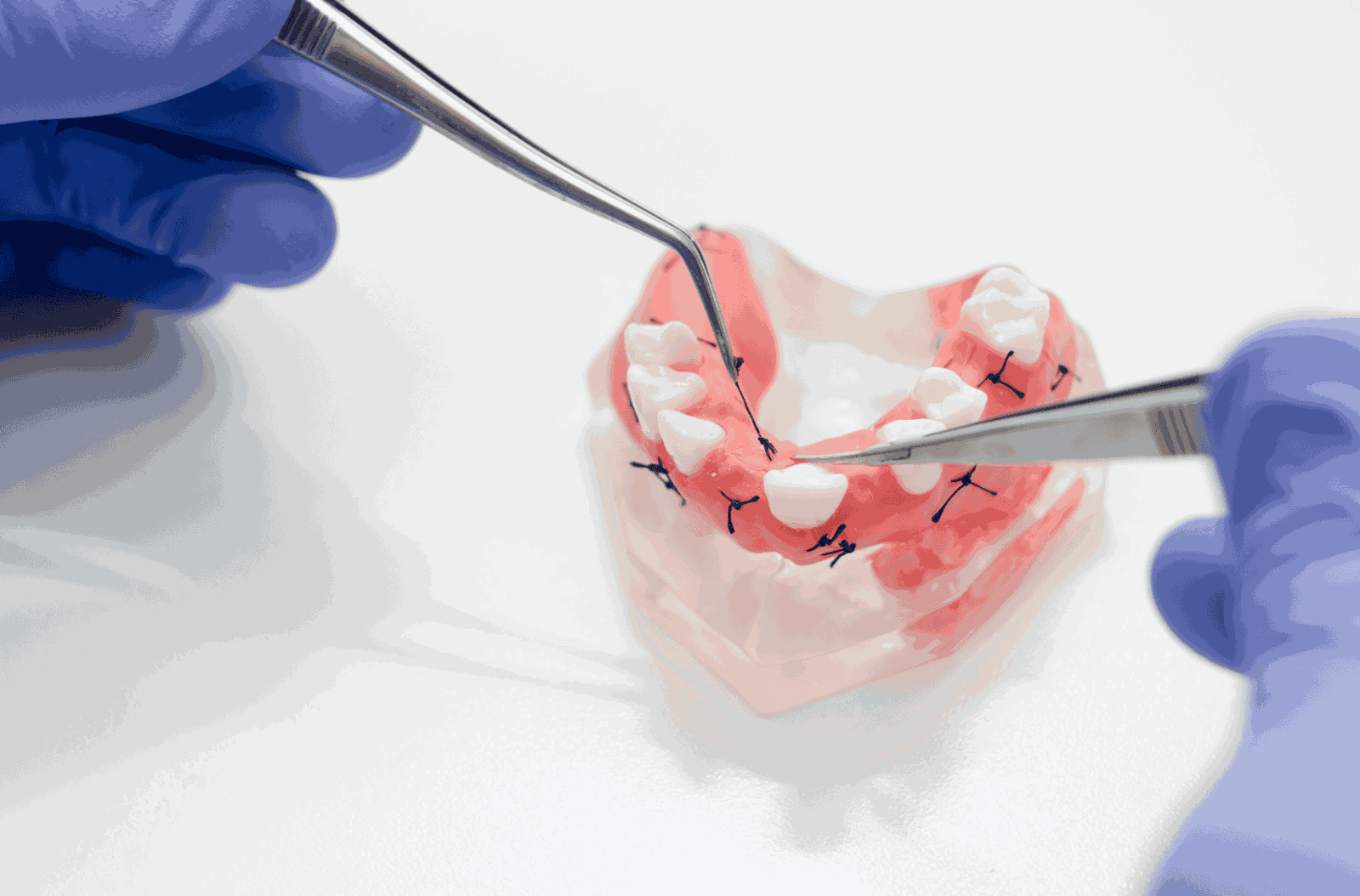 implant supported dentures in worchester, ma