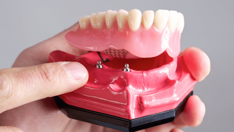 Implant-Supported Dentures in Southington, CT