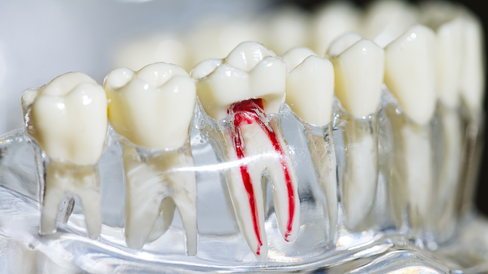 How Painful Is the Root Canal Procedure?