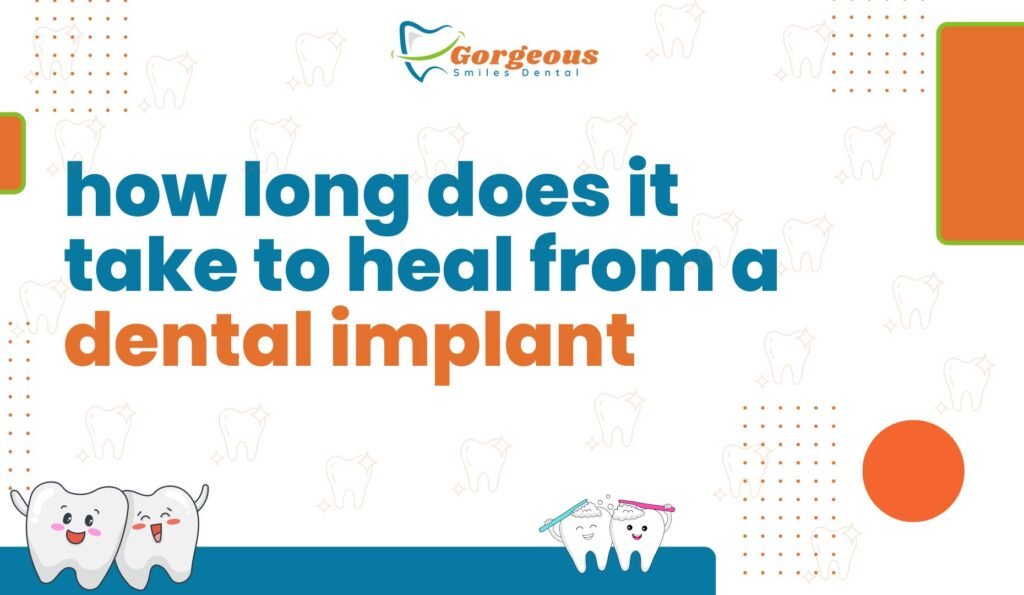 Illustration explaining the healing timeline for a dental implant, showing stages from initial surgery to complete recovery. The process typically takes several months, including bone integration and tissue healing, varying based on individual health and bone quality.