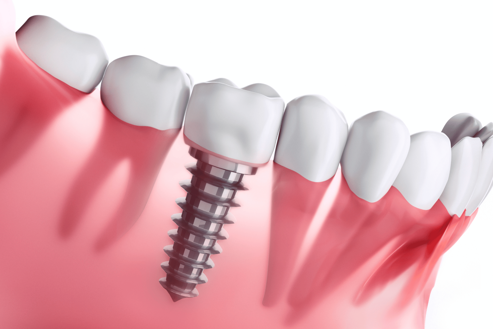 Implant-Supported Dentures in Springfield