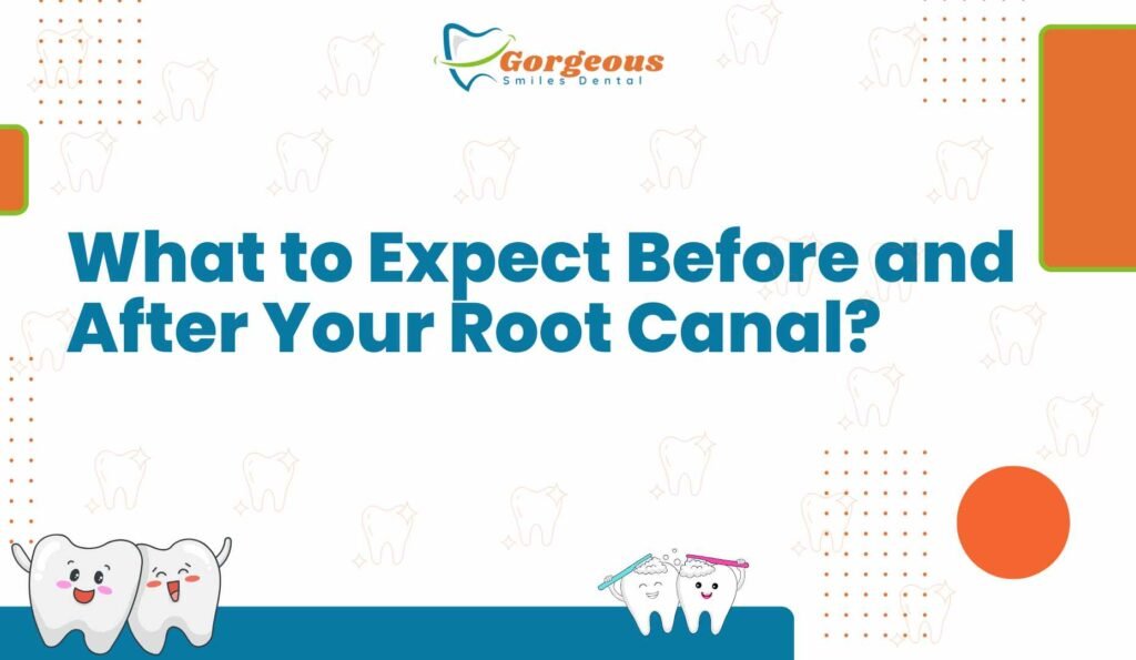 What to Expect Before and After Your Root Canal?