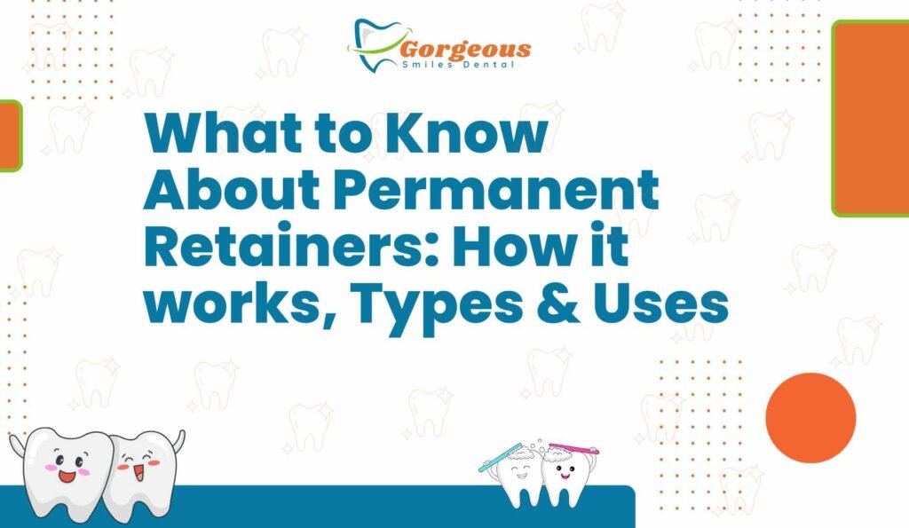 What to Know About Permanent Retainers: How It Works, Types & Uses