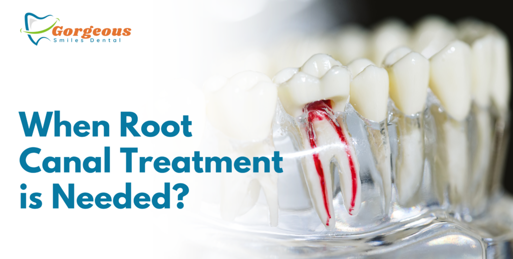 When Root Canal Treatment is Needed?