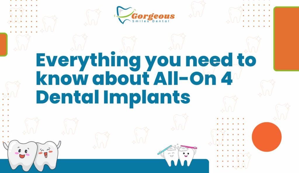 Everything You Need to Know About All-On 4 Dental Implants