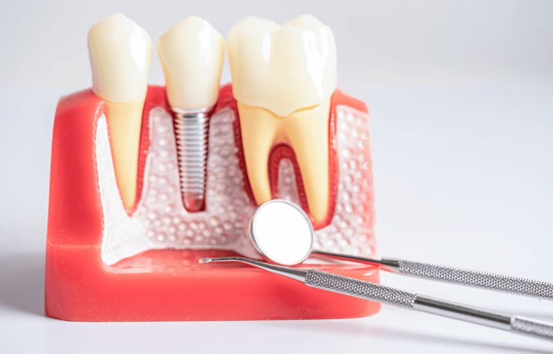 Dental implants services in Southington