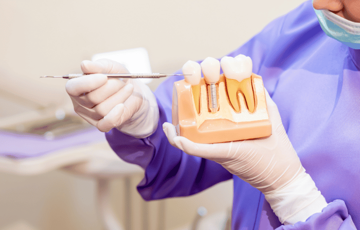 Implant-Supported Dentures in Farmington