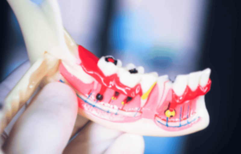 Root Canal & Endodontics in farmington ct