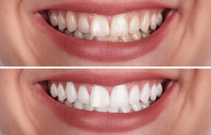 Teeth whitening service in Southington