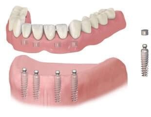 dentures