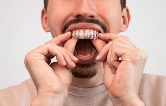 invisalign in chicopee, ma