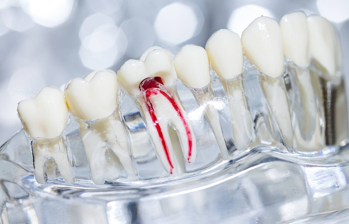 Root Canal & Endodontics in Hartford, CT