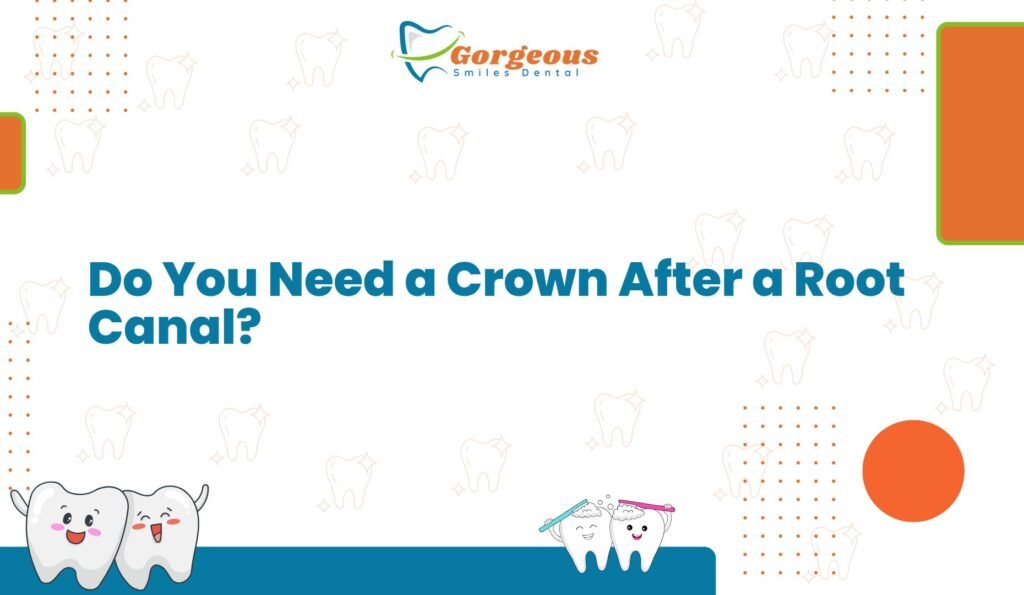 Do You Need a Crown After a Root Canal?