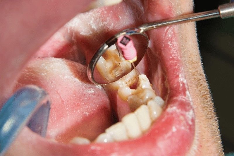 Fillings Crowns Bridge in Hartford