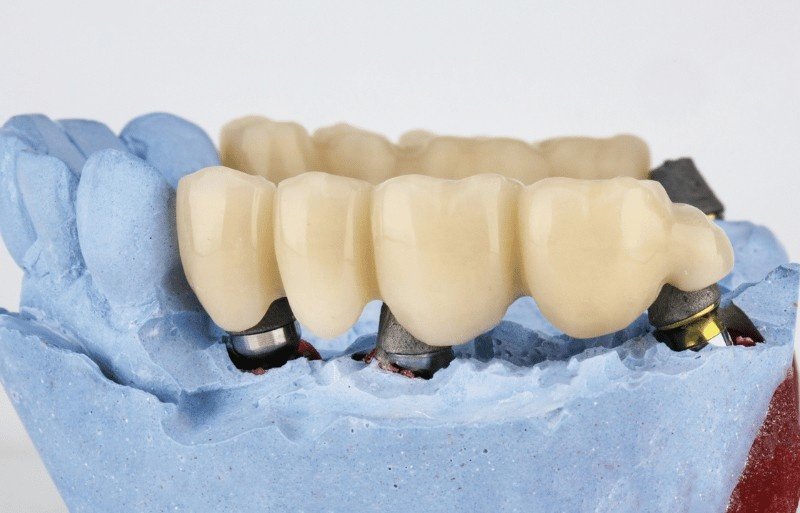 Fillings Crowns Bridge in Worcester