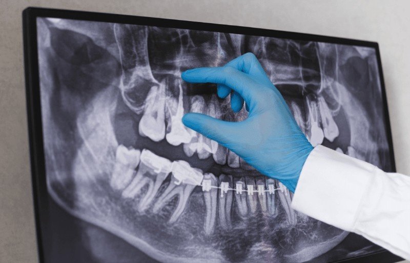 Root Canal Endodontics in Northampton