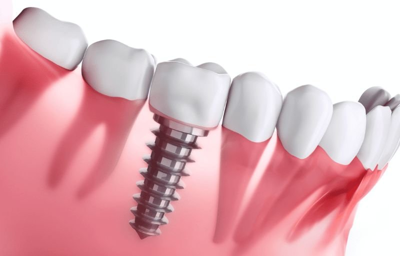 Implant-Supported Dentures in Springfield
