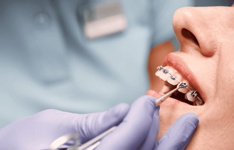 braces in springfeild ma