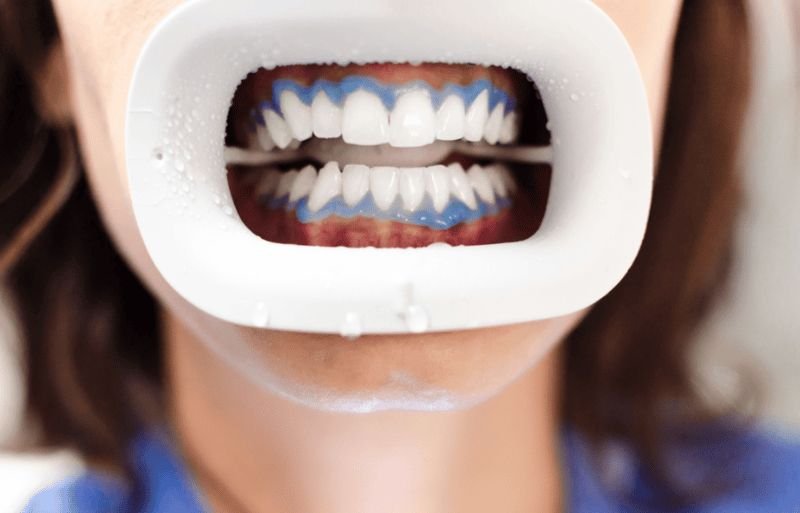 dental exam Teeth Cleaning in northampton ma