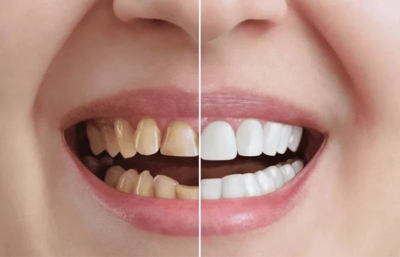 teeth whitening in chicopee ma